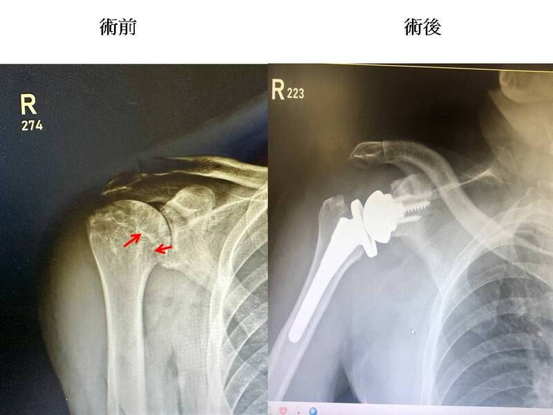 反置肩關節換術創奇蹟  八旬翁重燃網球冠軍夢